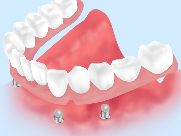 矢口渡（大田区・蒲田）の歯医者、のびのび歯科・矯正歯科で入れ歯治療