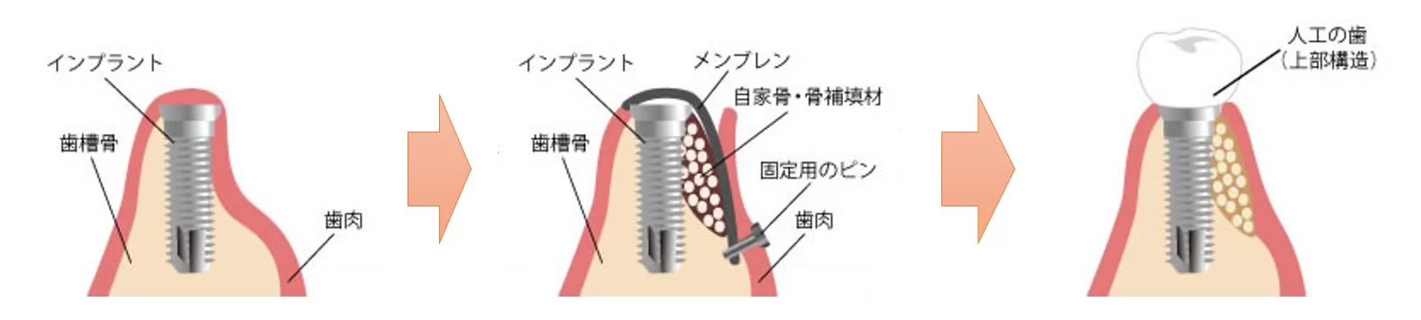 矢口渡（大田区・蒲田）の歯医者、のびのび歯科・矯正歯科でのGBR法