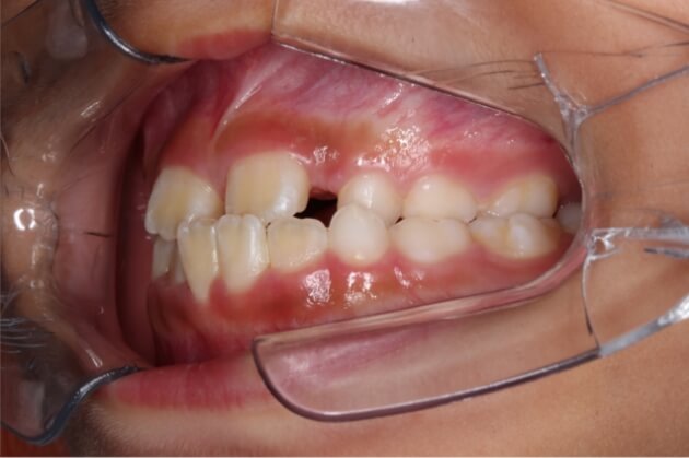 矢口渡（大田区・蒲田）の歯医者、のびのび歯科・矯正歯科で子供の成長発育矯正