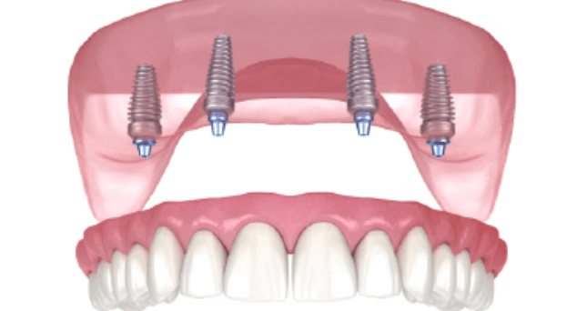 矢口渡（大田区・蒲田）の歯医者、のびのび歯科・矯正歯科でインプラント