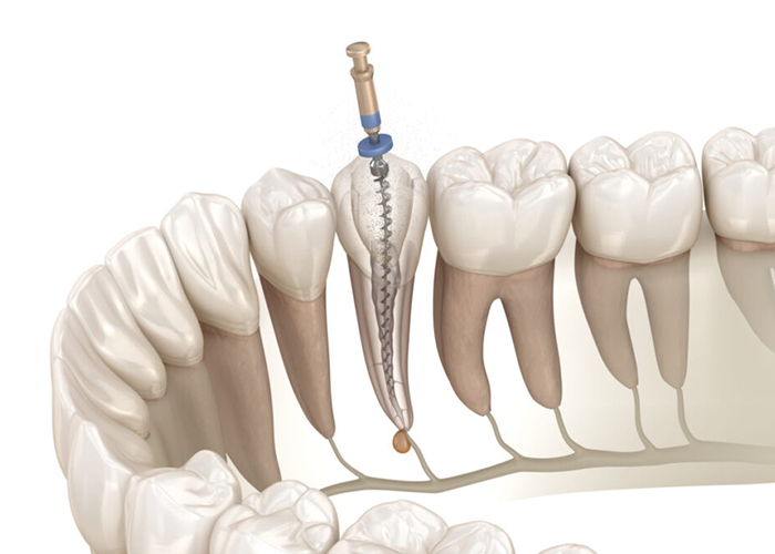 矢口渡（大田区・蒲田）の歯医者、のびのび歯科・矯正歯科のマイクロスコープ精密治療
