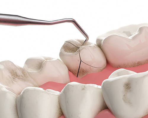 矢口渡（大田区・蒲田）の歯医者、のびのび歯科・矯正歯科のマイクロスコープ精密治療