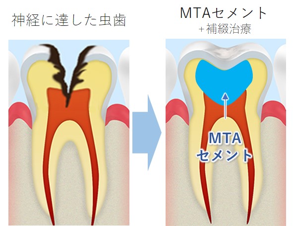 矢口渡（大田区・蒲田）の歯医者、のびのび歯科・矯正歯科のMTAセメント