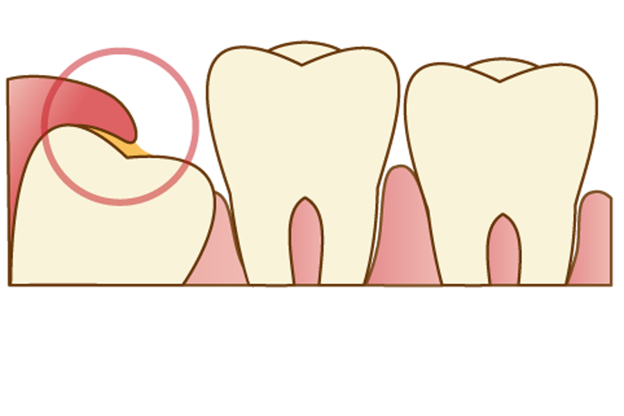 矢口渡（大田区・蒲田）の歯医者、のびのび歯科・矯正歯科で親知らずの抜歯