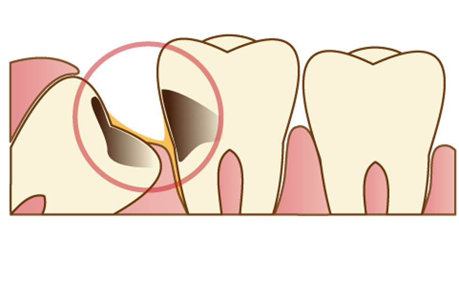 矢口渡（大田区・蒲田）の歯医者、のびのび歯科・矯正歯科で親知らずの抜歯