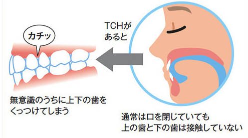 矢口渡（大田区・蒲田）の歯医者、のびのび歯科・矯正歯科の歯列接触癖対策